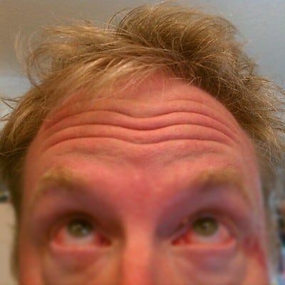 Finasteride Hårtap